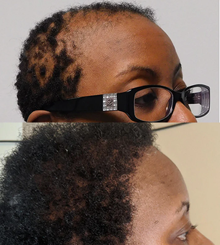 Huile de Batana™ | L'huile de croissance des cheveux, de traitement capillaire pure pour tous les types de cheveux