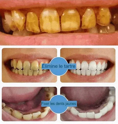 Blanchiment de vos dents en douceur en 15 jours grâce à la puissance de la Niacinamide