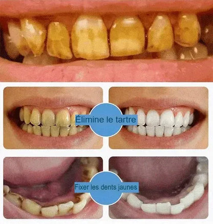 Blanchiment de vos dents en douceur en 15 jours grâce à la puissance de la Niacinamide