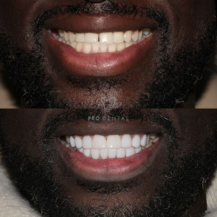 Blanchiment de vos dents en douceur en 15 jours grâce à la puissance de la Niacinamide