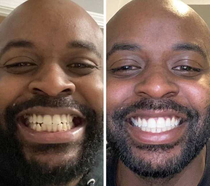 Blanchiment de vos dents en douceur en 15 jours grâce à la puissance de la Niacinamide