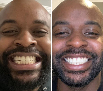 Blanchiment de vos dents en douceur en 15 jours grâce à la puissance de la Niacinamide